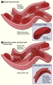 Sickle_cell_01