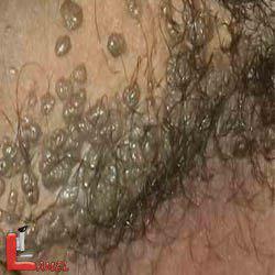 زگیل تناسلی/کوندیلوما آکومیناتوم/ بیماری های دستگاه تناسلی