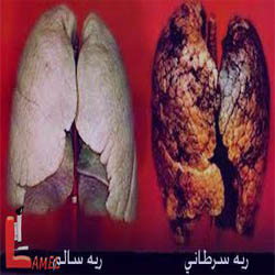 همه چیز در مورد سرطان ریه / علت و عوارض سرطان ریه همراه با روش درمان آن