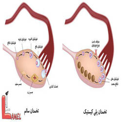 نکاتی درمورد سرطان تخمدان و بیماری های مربوط به تخمدان
