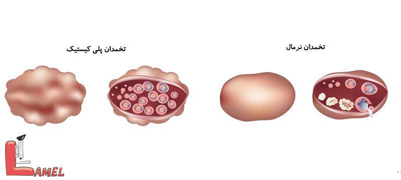 نکاتی درمورد سرطان تخمدان و بیماری های مربوط به تخمدان