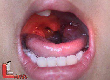 سرطان دهان / همه چیز در مورد سرطان دهان