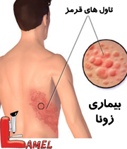 بیماری واریسلا یا آبله مرغان (chicken pox)/ ویروس واریسلا- زوستر