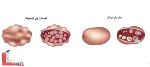 نکاتی درمورد سرطان تخمدان و بیماری های مربوط به تخمدان