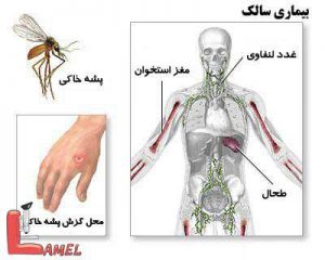 لیشمانیوز جلدی یا بیماری سالک / بیماری مربوط به پشه خاکی