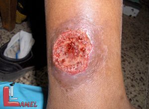 لیشمانیوز جلدی یا بیماری سالک / بیماری مربوط به پشه خاکی