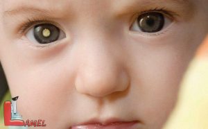 اطلاعاتی در مورد سرطان چشم و انواع آن / سرطان چشم کودکان / رتینوبلاستوما علت و درمان
