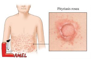 پیتریازیس‌ روزه‌آ یا جوش پولکی چیست؟ / شایع ترین بیماری پوستی