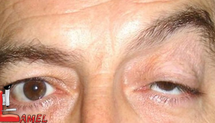 میاستنی گراویس نوعی فلج ماهیچه ای/خانم های جوان مراقب باشند