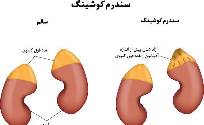 علت ایجاد سندرم کوشینگ وراه درمان آن
