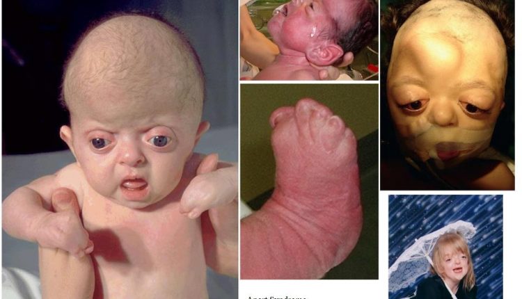 اختلال ژنتيكي سندرم آپرت Apert syndrome و علائم آن