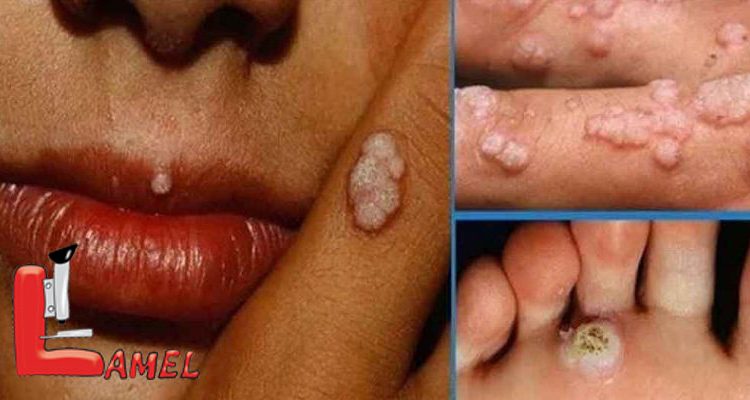 انواع ویروس HPV/ ویروس HPV سبب بیماریهای مختلف می شود