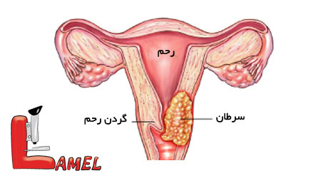 ویروس HPV ؛ ویروسی خطرناک در زنان و مردان/ شیوع اچ‌پی‌وی در ایران