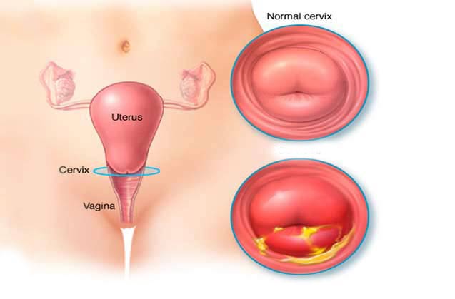 فتق واژن یا پرولاپس واژن چیست ؟علت و راه درمان آن