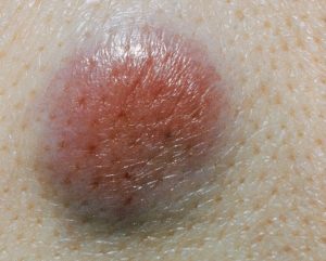 سرطان پوست چیست؟/ برخی از عوامل خطرابتلا به سرطان پوست