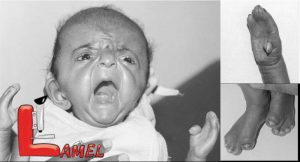 اختلال ژنتيكي سندرم آپرت Apert syndrome و علائم آن