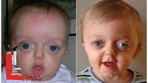 اختلال ژنتيكي سندرم آپرت Apert syndrome و علائم آن