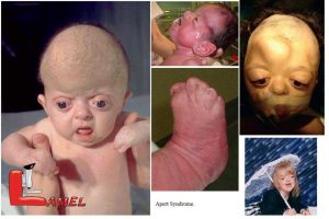 اختلال ژنتيكي سندرم آپرت Apert syndrome و علائم آن