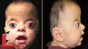 اختلال ژنتیکی سندرم آپرت