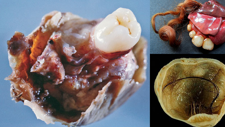 تومور تراتوم